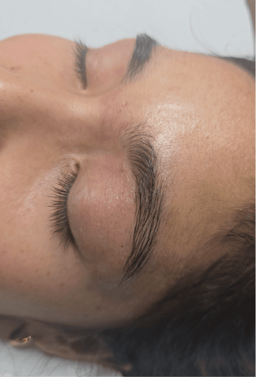 Après électrolyse - sourcils nets